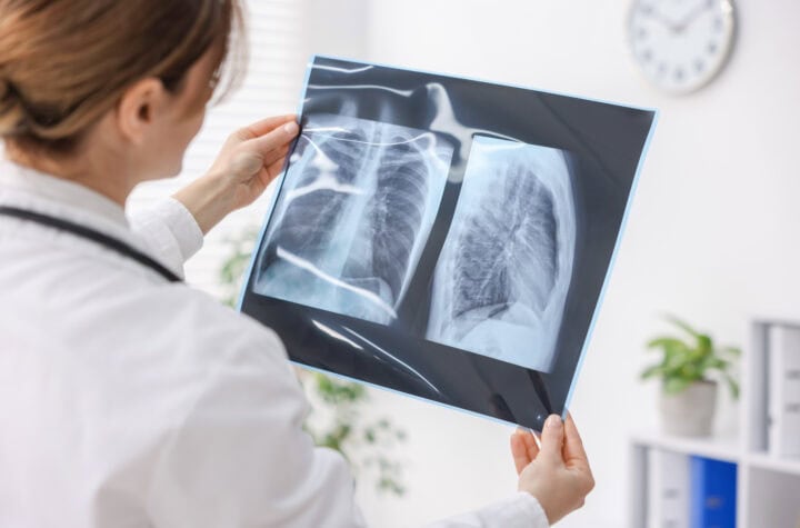 Lekar pregledava rentgen pluća u medicinskoj ordinaciji.